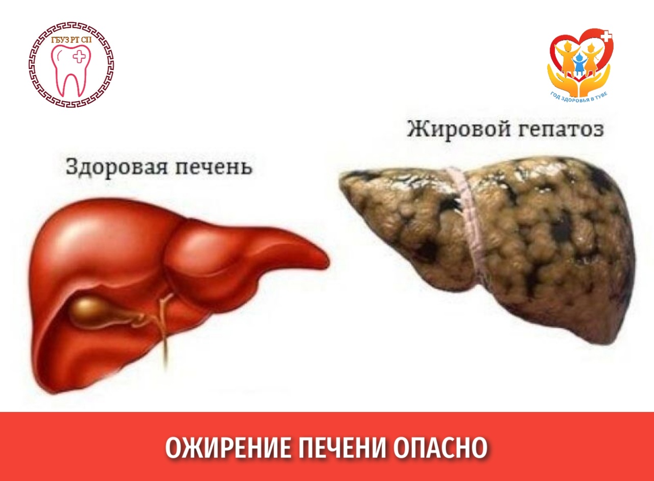 Ожирение печени опасно