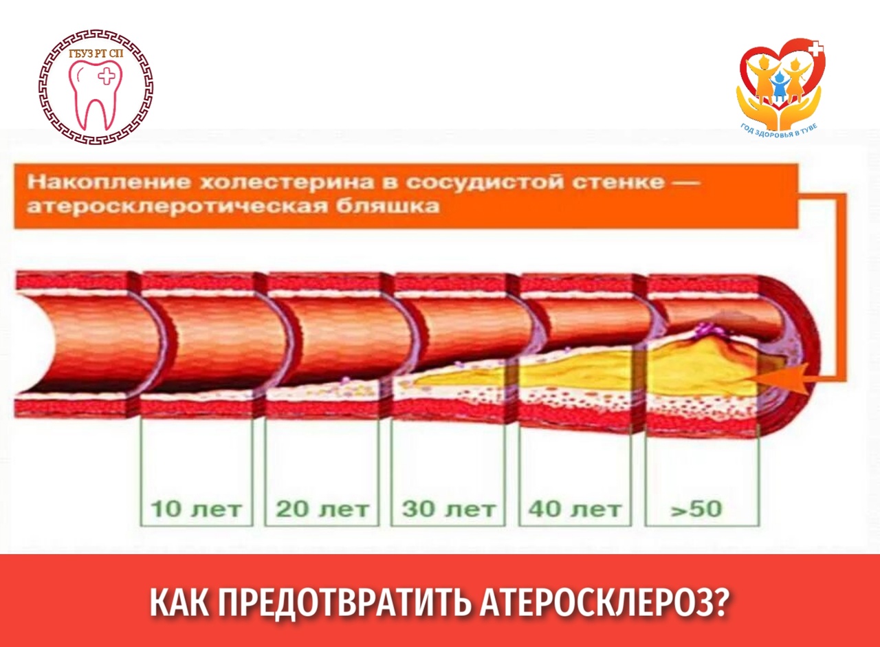 Как предотвратить атеросклероз?