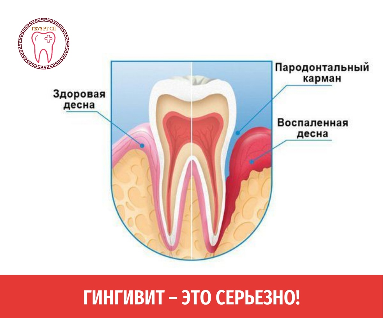 Что такое гингивит?