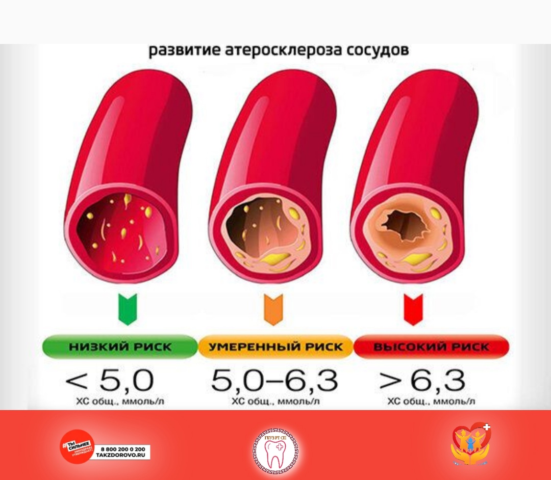 Высокий уровень холестерина в крови увеличивает риск для здоровья