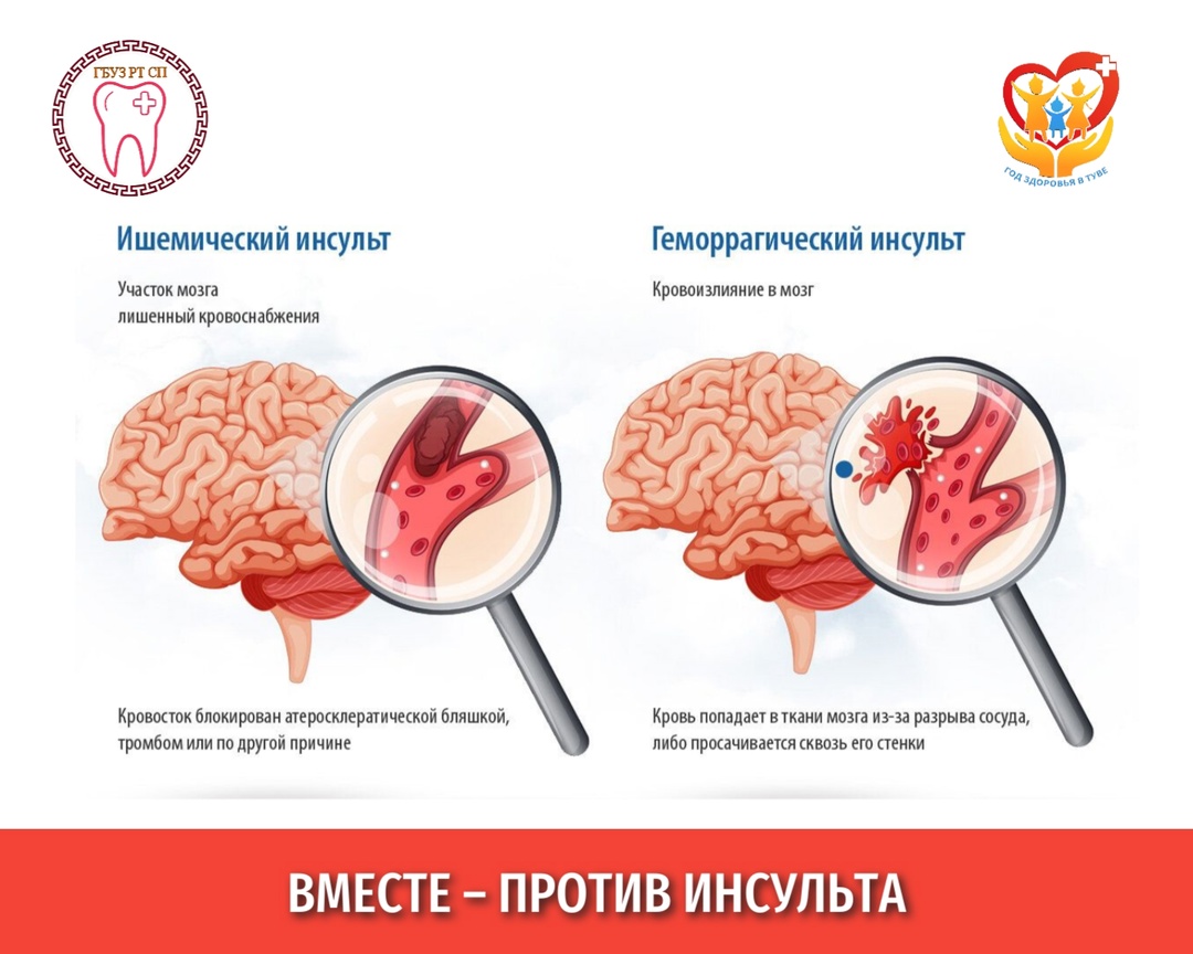 В России объявлена Неделя борьбы с инсультом с 28 октября по 3 ноября 2024 года