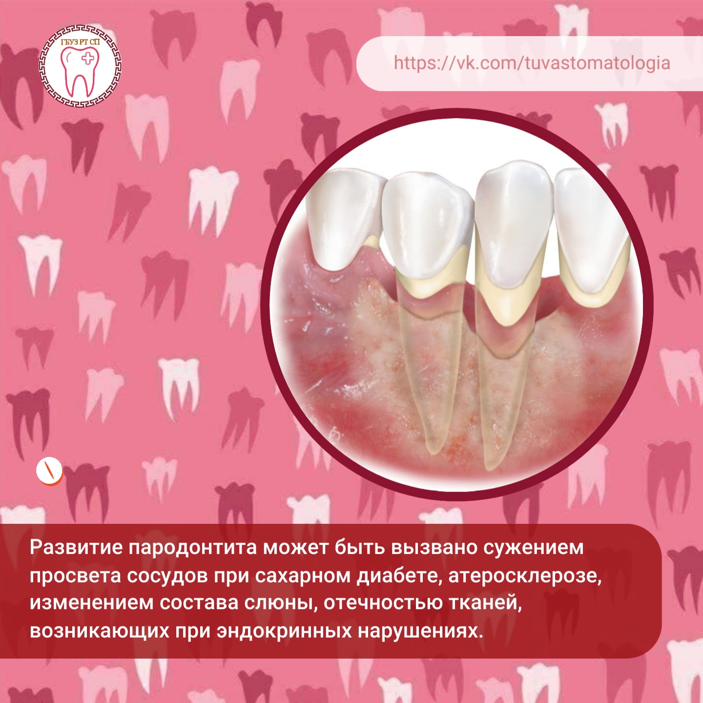 🦷Как возникает пародонтит?