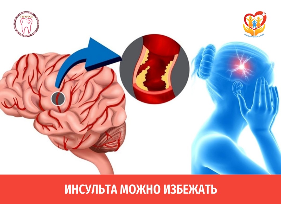 Факторы, которые могут спровоцировать инсульт: